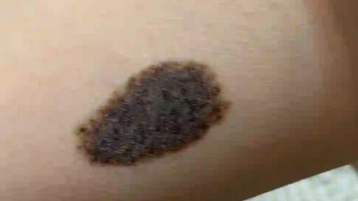 成都宝宝黑胎记如何治疗